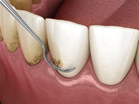 The Scaling & Root Planing Procedure — Charlotte Dental Esthetics