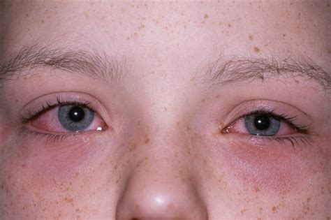 Allergies - Symptoms - NHS