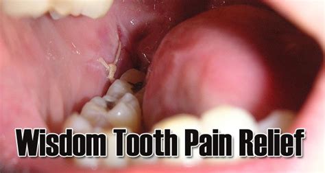 Home Remedies To Get Wisdom Teeth Pain Relief - Yabibo