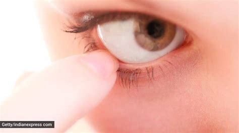 Don’t ignore that white spot in the eye | Health News - The Indian Express