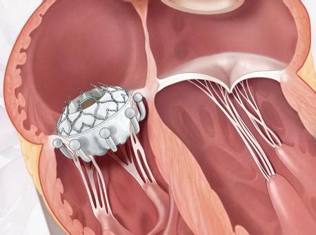 Mitral Valve Repair, Heart Valve Disease, Tricuspid Valve, Health ...