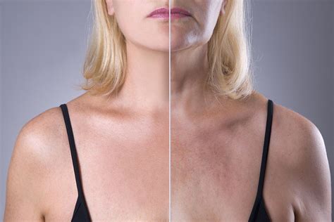 Facelift Side Effects and Risks: When to Call Your Doctor - Buffalo, NY