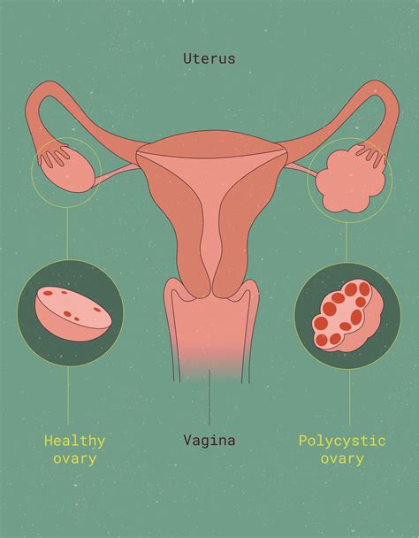 Normal Vs Polycystic Ovaries Ultrasound