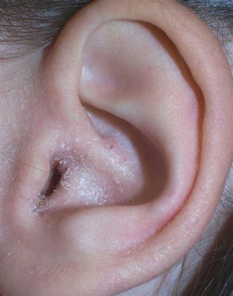 Crusty Ears: Causes and Treatments | Safe Symptoms