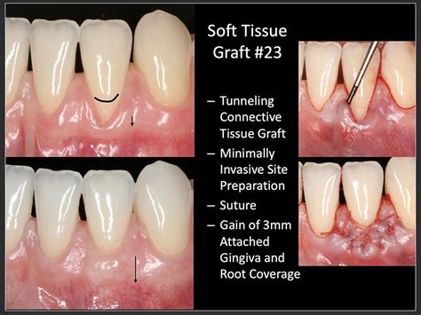 Gum Grafting Huntington Beach | Cosmetic Periodontics | Dr. Braga