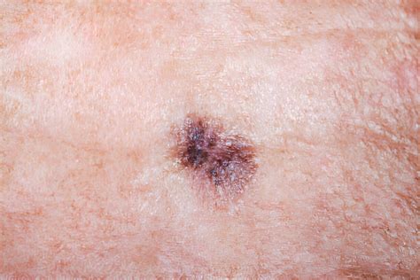 Melanoma Skin Cancer Has Reached an All-Time High in the UK - According to a Survey - StoryMag