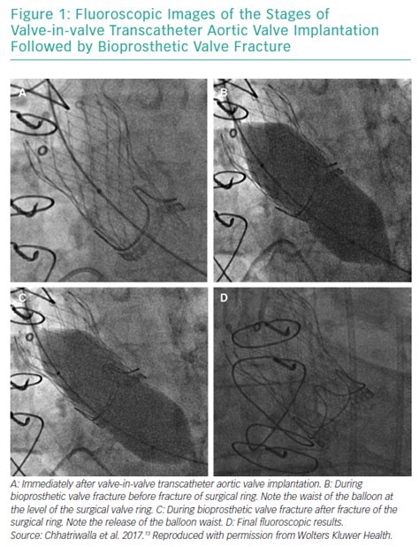 Bioprosthetic Aortic Valve Fracture During Valve-in-valve Transcatheter ...