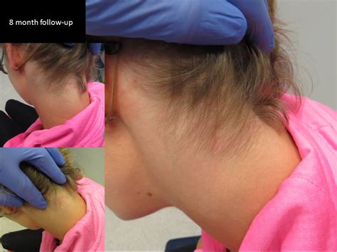 Case example - neck apocrine cystadenoma presenting clinically similar ...