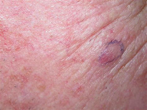 ACD A-Z of Skin - Merkel cell carcinoma