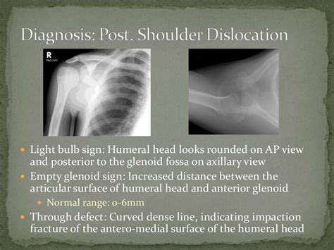 Posterior Shoulder Dislocation