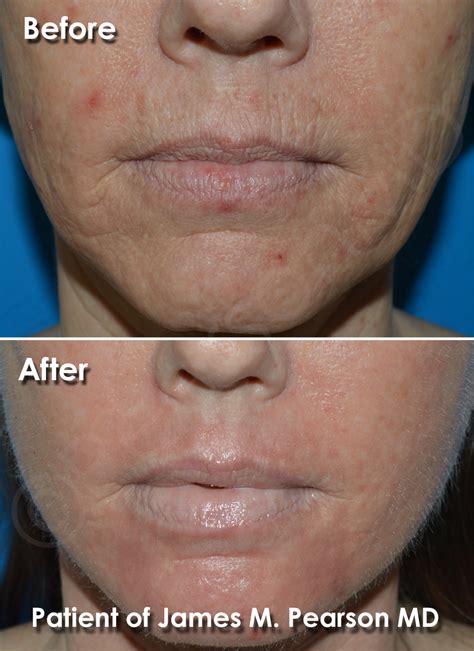 Dermabrasion Photos - Before & After - Dr. James Pearson Facial Plastic ...