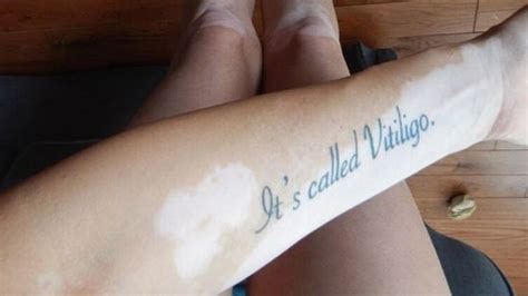 Woman Shares Photo Of Poignant Vitiligo Tattoo To Educate Those Who ...