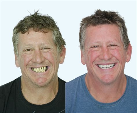 All-on-4 Dental Implants - Creative Smiles