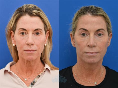 Eyelid Surgery Before and After Photo Gallery | Charlotte, NC | Dilworth Facial Plastic Surgery