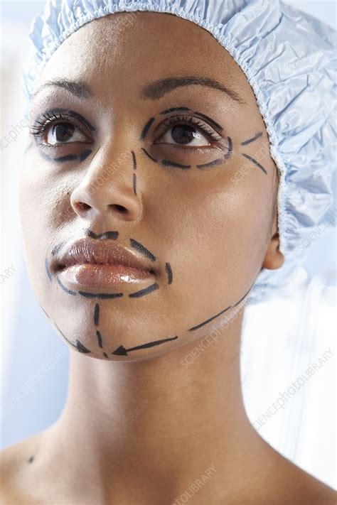 Facelift surgery markings - Stock Image - F002/5147 - Science Photo Library