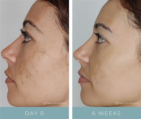 Before + After - Hyperpigmentation 2 - NeoGenesis