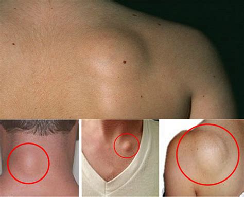 Avoid Your Surgery: Recipe for Removal of Fatty Tissue (Lipoma) in Just 8 Days - 3inaa