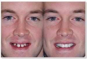 21 Dental Implant Before and After Photos