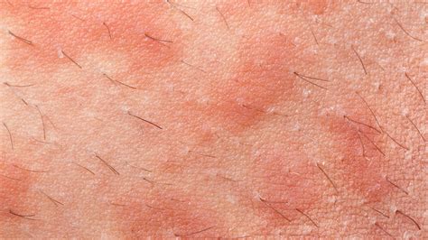 Atopic Dermatitis | Types Of Eczema | Gladskin