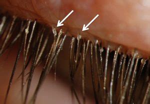 Your eyes. Your makeup. A case of demodex mites. – We Love Eyes ...