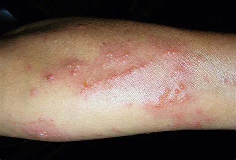 allergic contact dermatitis Picture Image on MedicineNet.com