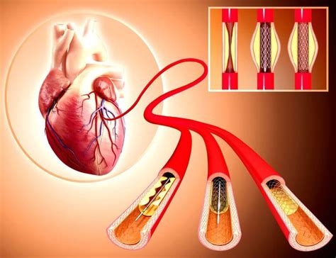 PCI stents & ballooning of coronary arteries | Free consultation