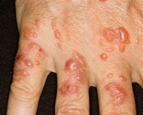 Contact Dermatitis - Pictures, Symptoms, Causes, Treatment | HubPages