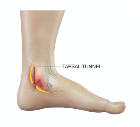 Tarsal Tunnel Syndrome - Symmetry Physical Therapy | Miami