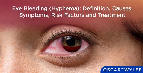 Eye Bleeding (Hyphema): Definition, Causes, Symptoms, Risk Factor and Treatment