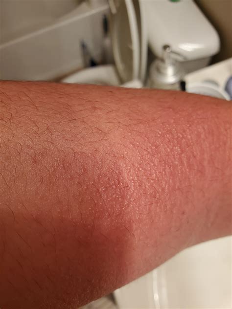 Red Skin Rash On Arm