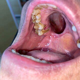 Palatal side of upper teeth immediately after SRP. | Download Scientific Diagram