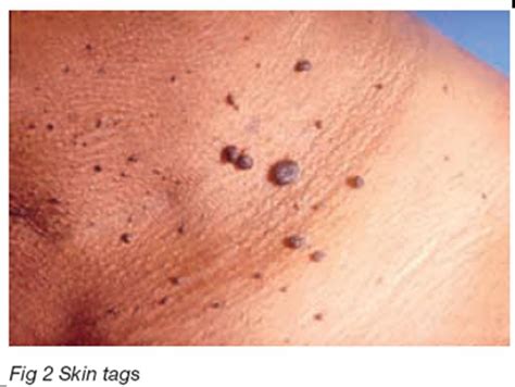 Benign Skin Tumours | National Skin Centre - NSC