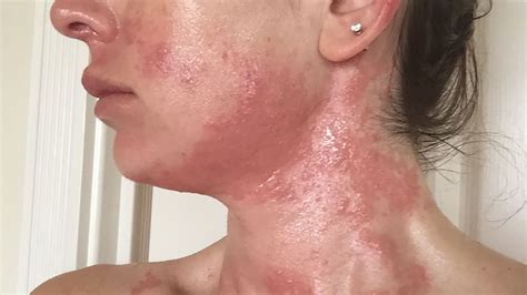 Hives On Neck And Face