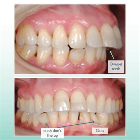 5 Reasons to Steer Clear of So-Called "Permanent" Retainers - Ortho Arts | Dr. Jared Gianquinto ...