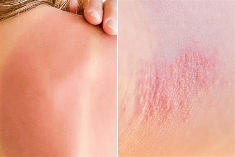 Heat Rash or Sunburn: Here’s How to Tell the Difference | Reader's Digest