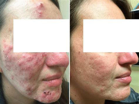 Cystic Acne Treated with Accutane Alternative