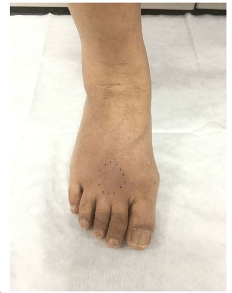 Picture of the affected foot, with the black dots highlighting the... | Download Scientific Diagram