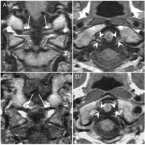 Are MRI high-signal changes of alar and transverse ligaments in acute whiplash injury related to ...