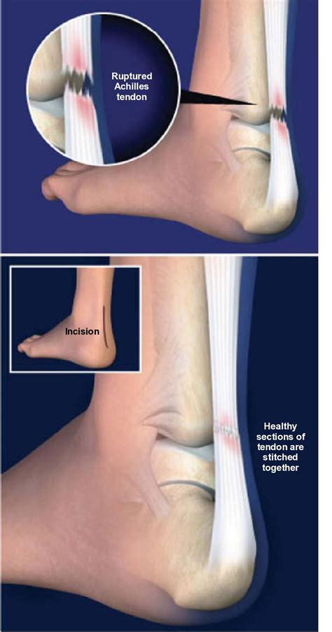 Achilles Tendon Tear Surgery