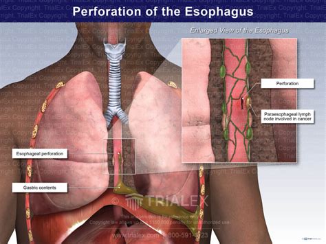 Perforation of the Esophagus - Trial Exhibits Inc.