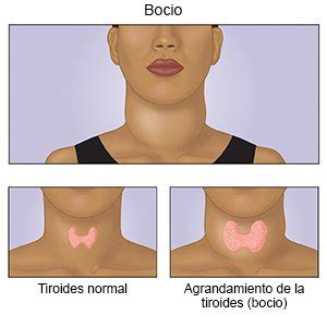 Tiroides: todo lo que necesita saber sobre la glándula de mariposa