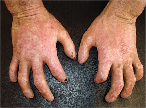 Scleroderma-Like Hands in a 16-Year-Old Boy | Dermatology | JAMA ...