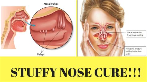 how to get rid of a blocked nose in 5 minutes - YouTube