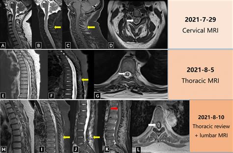 The patient’s cervical, thoracic and lumbar spine MRI. A–D are the ...