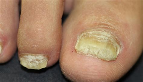 Derm Dx: Thickened toenails - Clinical Advisor