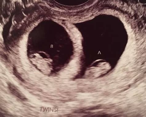 100 Weeks Pregnant With Twins