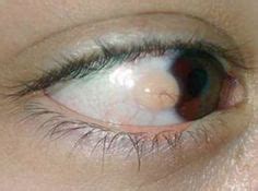 7 Bump on Eyeball ideas | eyeball, parts of the eyeball, pimples