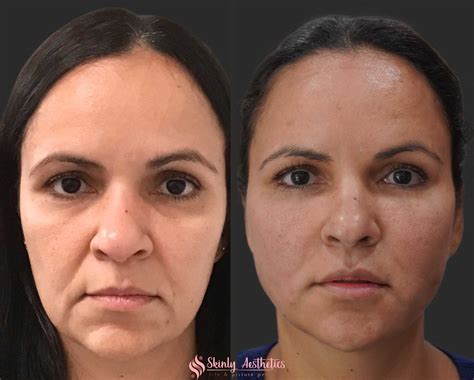 PDO Thread Lifting - Before and After Results at Skinly Aesthetics