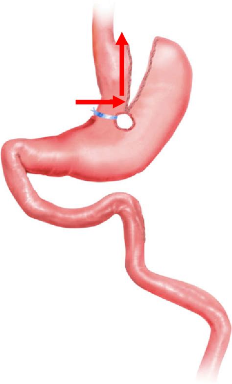 [PDF] Short-and Long-Term Outcomes of Vertical Banded Gastroplasty Converted to Roux-enY Gastric ...