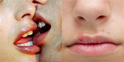 5 Diseases And Infections You Can Get From Kissing | SELF